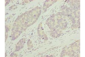 Immunohistochemistry of paraffin-embedded human gastric cancer using ABIN7163654 at dilution of 1:100 (GNRPX Antikörper  (AA 1-149))