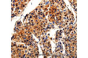 Immunohistochemistry of Human liver cancer using APLP1 Polyclonal Antibody at dilution of 1:10 (APLP1 Antikörper)
