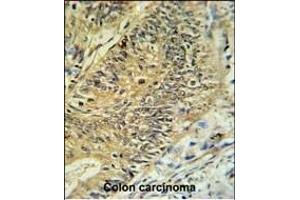 RPS15A Antibody (N-term) (ABIN650999 and ABIN2840032) IHC analysis in formalin fixed and paraffin embedded colon carcinoma followed by peroxidase conjugation of the secondary antibody and DAB staining. (RPS15A Antikörper  (N-Term))
