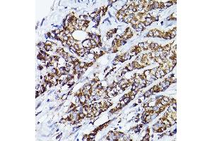 Immunohistochemistry of paraffin-embedded human breast cancer using VD Rabbit pAb (ABIN7271337) at dilution of 1:150 (40x lens). (VDAC2 Antikörper  (AA 1-100))