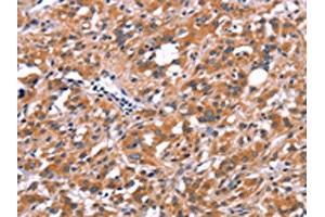 The image on the left is immunohistochemistry of paraffin-embedded Human thyroid cancer tissue using ABIN7190640(FDCSP Antibody) at dilution 1/25, on the right is treated with synthetic peptide. (FDCSP Antikörper)