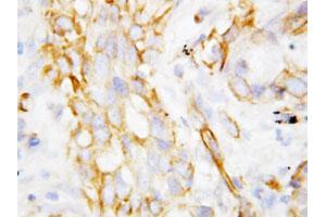 Immunohistochemical staining of paraffin-embedded human lung cancer tissue section with DEFB1 polyclonal antibody . (beta Defensin 1 Antikörper  (C-Term))