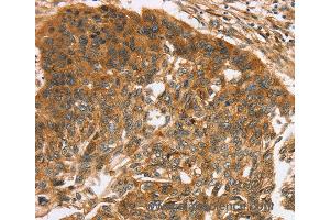 Immunohistochemistry of Human esophagus cancer using TNFSF15 Polyclonal Antibody at dilution of 1:40 (TNFSF15 Antikörper)