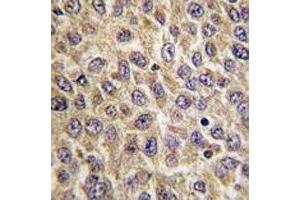 IHC analysis of FFPE human hepatocarcinoma tissue stained with ILK antibody (ILK Antikörper  (AA 225-253))