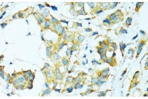 Immunohistochemistry of paraffin-embedded Human breast cancer using CYP2B6 Polyclonal Antibody at dilution of 1:100 (40x lens). (CYP2B6 Antikörper)