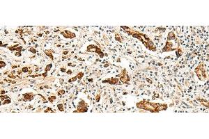 Immunohistochemistry of paraffin-embedded Human prost at e cancer tissue using GPR160 Polyclonal Antibody at dilution of 1:35(x200) (GPR160 Antikörper)