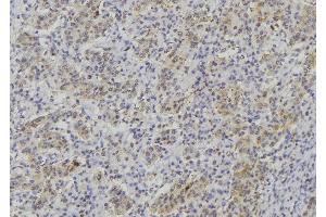 ABIN6277021 at 1/100 staining Human lung cancer tissue by IHC-P. (TPSAB1 Antikörper  (C-Term))