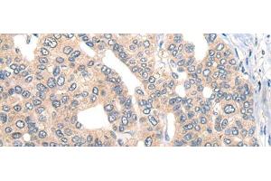 Immunohistochemistry of paraffin-embedded Human liver cancer tissue using CORO2B Polyclonal Antibody at dilution of 1:50(x200) (CORO2B Antikörper)