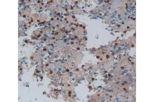 Used in DAB staining on fromalin fixed paraffin- embedded lung cancer tissue (LGALS13 Antikörper  (AA 1-139))