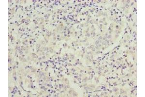 Immunohistochemistry of paraffin-embedded human lung cancer using ABIN7166922 at dilution of 1:100 (C9orf64 Antikörper  (AA 182-341))