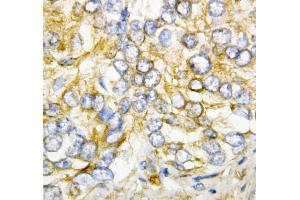 Anti-AIMP2/p38 antibody, IHC(P) IHC(P): Human Rectal Cancer Tissue (AIMP2 Antikörper  (Middle Region))