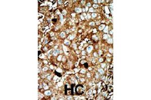 Formalin-fixed and paraffin-embedded human hepatocellular carcinoma tissue reacted with PFKFB3 polyclonal antibody  , which was peroxidase-conjugated to the secondary antibody, followed by AEC staining.