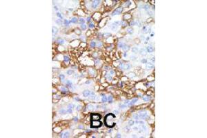 Formalin-fixed and paraffin-embedded human cancer tissue reacted with MAP4K1 polyclonal antibody  , which was peroxidase-conjugated to the secondary antibody, followed by DAB staining. (MAP4K1 Antikörper  (C-Term))