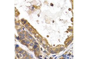 Immunohistochemistry of paraffin-embedded human stomach cancer using GYS1 antibody at dilution of 1:200 (400x lens). (Glycogen Synthase 1 Antikörper)