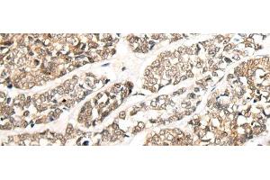 Immunohistochemistry of paraffin-embedded Human esophagus cancer tissue using CCDC181 Polyclonal Antibody at dilution of 1:50(x200) (C1orf114 Antikörper)