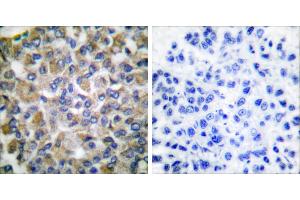 Peptide - +Immunohistochemical analysis of paraffin-embedded human breast carcinoma tissue using GRP75 antibody (#C0216). (HSPA9 Antikörper)