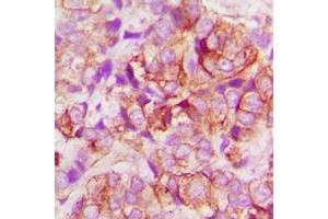 Immunohistochemical analysis of BAX staining in human lung cancer formalin fixed paraffin embedded tissue section. (BAX Antikörper  (N-Term))