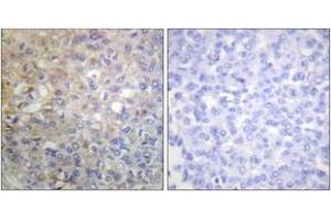 Immunohistochemistry analysis of paraffin-embedded human breast carcinoma tissue, using FGFR1 (Ab-766) Antibody. (FGFR1 Antikörper  (AA 736-785))