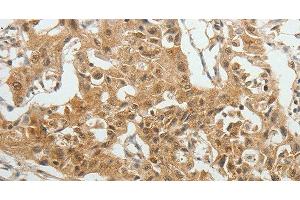 Immunohistochemistry of paraffin-embedded Human lung cancer tissue using SYT6 Polyclonal Antibody at dilution 1:40 (SYT6 Antikörper)