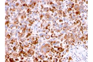Formalin-fixed, paraffin-embedded human Melanoma stained with CD63 Mouse Monoclonal Antibody (LAMP3/2788). (CD63 Antikörper  (AA 100-197))