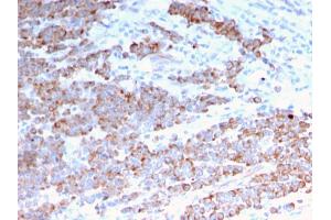 Formalin-fixed, paraffin-embedded human Colon Carcinoma stained with Cytokeratin 18 Mouse Monoclonal Antibody (rKRT18/1190). (Rekombinanter Cytokeratin 18 Antikörper)