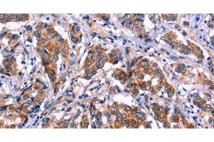 Immunohistochemistry of paraffin-embedded Human breast cancer tissue using EIF2AK4 Polyclonal Antibody at dilution 1:50 (GCN2 Antikörper)