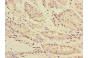 Immunohistochemistry of paraffin-embedded human gastric cancer using ABIN7166196 at dilution of 1:100 (TOB2 Antikörper  (AA 1-70))