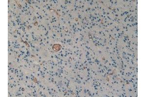 DAB staining on IHC-P; Samples: Human Glioma Tissue (Urotensin 2 Antikörper  (AA 20-120))