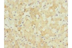 Immunohistochemistry of paraffin-embedded human liver cancer using ABIN7154045 at dilution of 1:100 (GATC Antikörper  (AA 1-136))