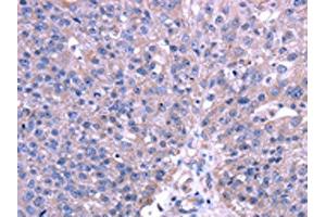 The image on the left is immunohistochemistry of paraffin-embedded Human breast cancer tissue using ABIN7131486(TRIM49 Antibody) at dilution 1/40, on the right is treated with fusion protein. (TRIM49 Antikörper)