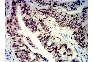 Immunohistochemical analysis of paraffin-embedded rectum cancer tissues using BTRC mouse mAb with DAB staining. (BTRC Antikörper  (AA 24-151))