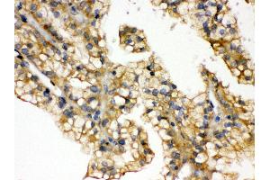 Anti- Aquaporin 2 Picoband antibody, IHC(P) IHC(P): Human Kidney Cancer Tissue (AQP2 Antikörper  (C-Term))