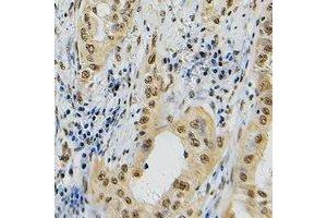 Immunohistochemical analysis of Topoisomerase 2 alpha staining in human lung cancer formalin fixed paraffin embedded tissue section. (Topoisomerase II alpha Antikörper  (C-Term))