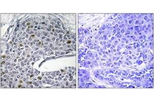 Immunohistochemistry analysis of paraffin-embedded human lung carcinoma tissue, using IRF3 (Ab-385) Antibody. (IRF3 Antikörper  (AA 351-400))