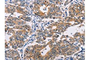 The image on the left is immunohistochemistry of paraffin-embedded Human gastic cancer tissue using ABIN7128293(AGPAT4 Antibody) at dilution 1/25, on the right is treated with fusion protein. (AGPAT4 Antikörper)