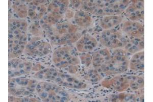 IHC-P analysis of Human Liver Cancer Tissue, with DAB staining. (COL4A1 Antikörper  (AA 1444-1669))