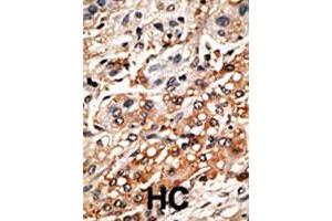 Formalin-fixed and paraffin-embedded human hepatocellular carcinoma tissue reacted with the BMF polyclonal antibody  , which was peroxidase-conjugated to the secondary antibody, followed by DAB staining. (BMF Antikörper  (AA 130-150))
