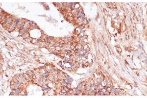 Immunohistochemistry of paraffin-embedded Human colon carcinoma using MAP2K3 Polyclonal Antibody at dilution of 1:100 (40x lens). (MAP2K3 Antikörper)