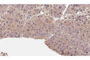 ABIN6278067 at 1/100 staining Human liver cancer tissue by IHC-P.