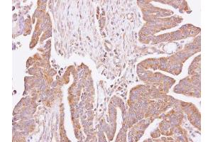 IHC-P Image Immunohistochemical analysis of paraffin-embedded human lung cancer, using C4orf19, antibody at 1:100 dilution. (C4orf19 Antikörper)