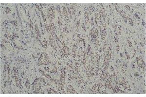 Immunohistochemistry of paraffin-embedded Human breast carcinoma tissue using TBP Monoclonal Antibody at dilution of 1:200. (TBP Antikörper)