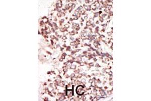 Formalin-fixed and paraffin-embedded human hepatocellular carcinoma tissue reacted with the PIM2 polyclonal antibody  , which was peroxidase-conjugated to the secondary antibody, followed by DAB staining. (PIM2 Antikörper  (C-Term))