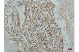 Immunohistochemical analysis of paraffin-embedded Human Lung Carcinoma using IκB β(mAb diluted at 1:200. (NFKBIB Antikörper)