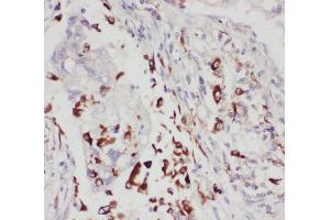 Anti-5 Lipoxygenase antibody, IHC(P) IHC(P): Human Lung Cancer Tissue (ALOX5 Antikörper  (C-Term))