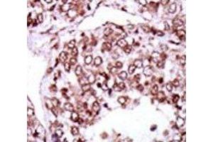 IHC analysis of FFPE human hepatocarcinoma stained with the CAMK2G antibody (CAMKII gamma Antikörper  (AA 309-338))