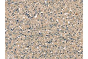 The image on the left is immunohistochemistry of paraffin-embedded Human breast cancer tissue using ABIN7192556(SMAGP Antibody) at dilution 1/40, on the right is treated with synthetic peptide. (SMAGP Antikörper)