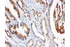 IHC-P: COX2 antibody testing of human intestinal cancer tissue (COX2 Antikörper  (AA 589-604))