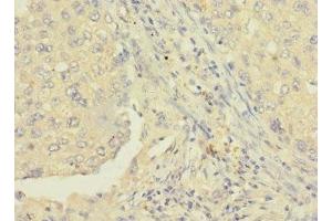 Immunohistochemistry of paraffin-embedded human lung cancer using ABIN7167385 at dilution of 1:100