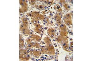 Formalin-fixed and paraffin-embedded human hepatocarcinoma with COL6A1 Antibody , which was peroxidase-conjugated to the secondary antibody, followed by DAB staining. (COL6A1 Antikörper  (C-Term))