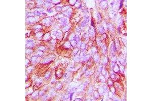 Immunohistochemical analysis of mPR alpha staining in human breast cancer formalin fixed paraffin embedded tissue section. (PAQR7 Antikörper  (C-Term))
